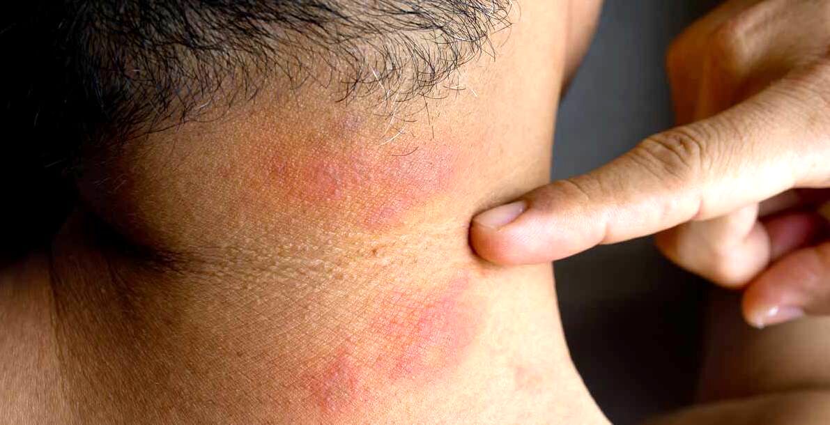 کمبود کدوم ویتامین ها باعث خارش بدن میشه؟