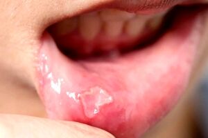 درمان آفت دهان با طب سنتی و گیاهان دارویی