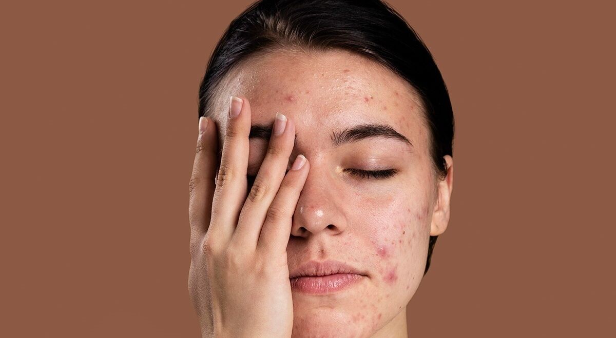 تاثیر مزاج در جوش زدن