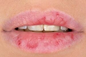 ویتامین ها چه ارتباطی با خشکی و پوسته شدن لب ها دارن؟ 