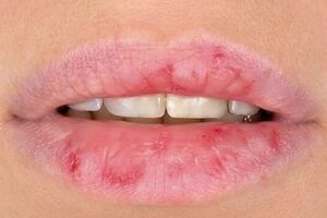 ویتامین ها چه ارتباطی با خشکی و پوسته شدن لب ها دارن؟ 