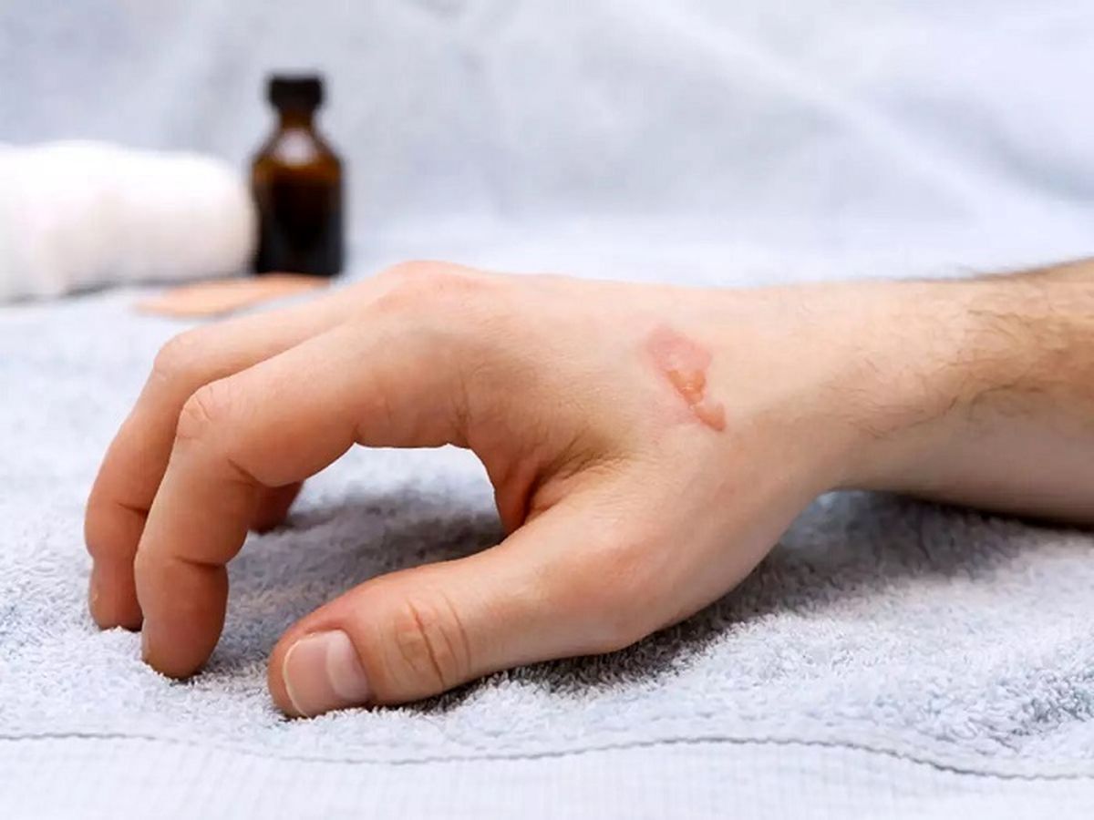 7 روغن طبیعی برای درمان خانگی سوختگی! + مزایا